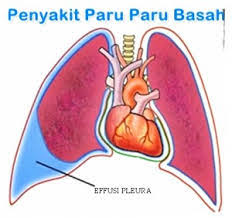 Illustration for article titled Apakah Penyakit Paru Paru Basah Berbahaya